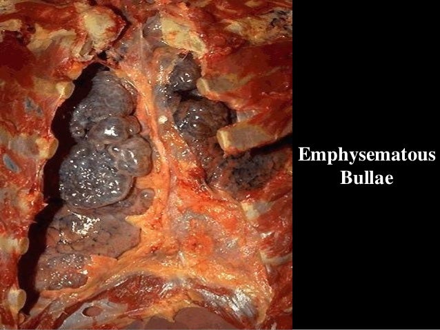Emphysema diagram of atelectasis 