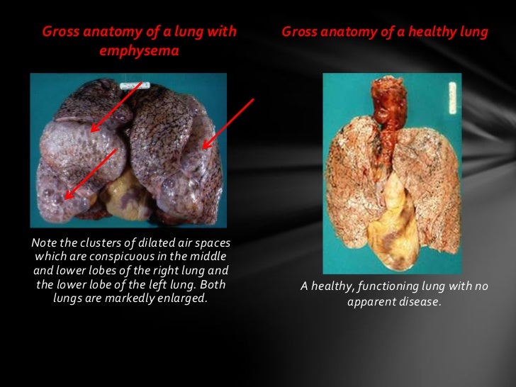 Emphysema and alfa 1 antitrypsin