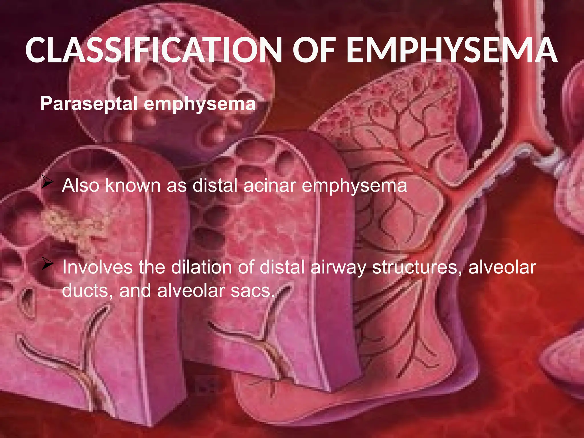 Emphysema Wind Instruments emphysema done.pptxhshshhshsshshshshhshhsss | PPTX