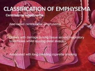 Emphysema Wind Instruments emphysema done.pptxhshshhshsshshshshhshhsss | PPTX