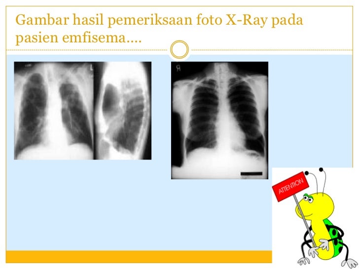 Emphysema Paru