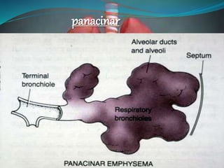 panacinar
 