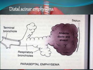 Distal acinar emphysema
 
