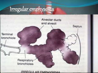 Irregular emphysema
 