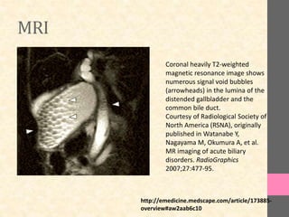 MRI
Coronal heavily T2-weighted
magnetic resonance image shows
numerous signal void bubbles
(arrowheads) in the lumina of the
distended gallbladder and the
common bile duct.
Courtesy of Radiological Society of
North America (RSNA), originally
published in Watanabe Y,
Nagayama M, Okumura A, et al.
MR imaging of acute biliary
disorders. RadioGraphics
2007;27:477-95.
http://emedicine.medscape.com/article/173885-
overview#aw2aab6c10
 