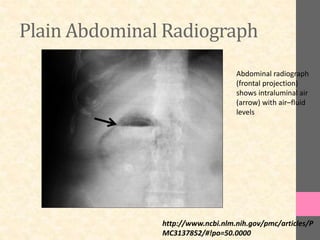 Plain Abdominal Radiograph
Abdominal radiograph
(frontal projection)
shows intraluminal air
(arrow) with air–fluid
levels
http://www.ncbi.nlm.nih.gov/pmc/articles/P
MC3137852/#!po=50.0000
 