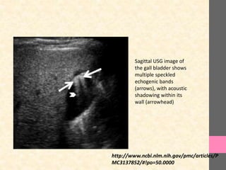 Sagittal USG image of
the gall bladder shows
multiple speckled
echogenic bands
(arrows), with acoustic
shadowing within its
wall (arrowhead)
http://www.ncbi.nlm.nih.gov/pmc/articles/P
MC3137852/#!po=50.0000
 