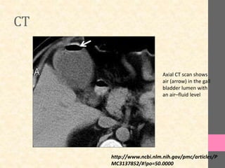 CT
Axial CT scan shows
air (arrow) in the gall
bladder lumen with
an air–fluid level
http://www.ncbi.nlm.nih.gov/pmc/articles/P
MC3137852/#!po=50.0000
 