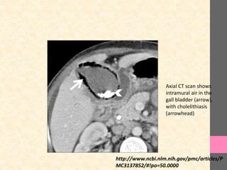 Axial CT scan shows
intramural air in the
gall bladder (arrow),
with cholelithiasis
(arrowhead)
http://www.ncbi.nlm.nih.gov/pmc/articles/P
MC3137852/#!po=50.0000
 