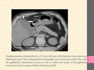 Emphysematous cholecystitis in a 47-year-old man with diabetes who experienced
abdominal pain. This computerized tomography scan shows gas within the wall of
the gallbladder (horizontal arrow) as well as within the lumen of the gallbladder
(verticalarrow).CourtesyofHelenMorehouse,MD.
http://emedicine.medscape.com/article/173885-
overview#aw2aab6c10
 