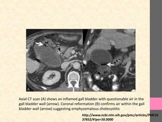 Axial CT scan (A) shows an inflamed gall bladder with questionable air in the
gall bladder wall (arrow). Coronal reformation (B) confirms air within the gall
bladder wall (arrow) suggesting emphysematous cholecystitis
http://www.ncbi.nlm.nih.gov/pmc/articles/PMC31
37852/#!po=50.0000
 