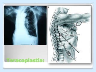 Toracoplastia: