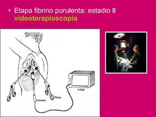 Etapa fibrino purulenta: estadio  II  videoterapioscopia 