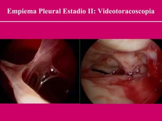 Empiema Pleural Estadio II: Videotoracoscopia 