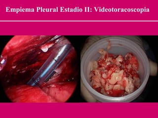 Empiema Pleural Estadio II: Videotoracoscopia 