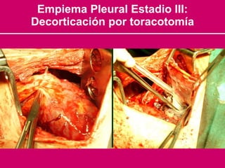 Empiema Pleural Estadio III: Decorticación por toracotomía 