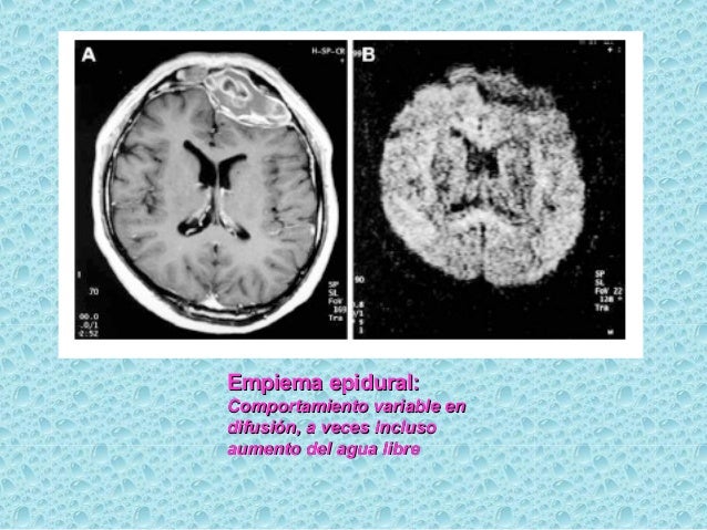Resultado de imagen para empiema epidural