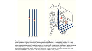 Empiema pleural PPT