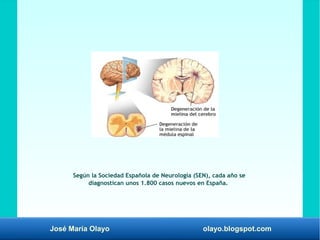 José María Olayo olayo.blogspot.com
Según la Sociedad Española de Neurología (SEN), cada año se
diagnostican unos 1.800 casos nuevos en España.
 