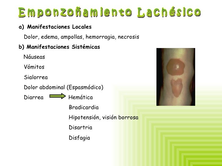 Emponzoñamiento ofidico