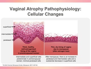 Vaginal Atrophy Pathophysiology:
Cellular Changes
Thick, healthy,
well-estrogenized
lining of the vagina
in premenopausal ...