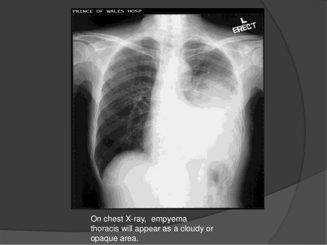 empyema
