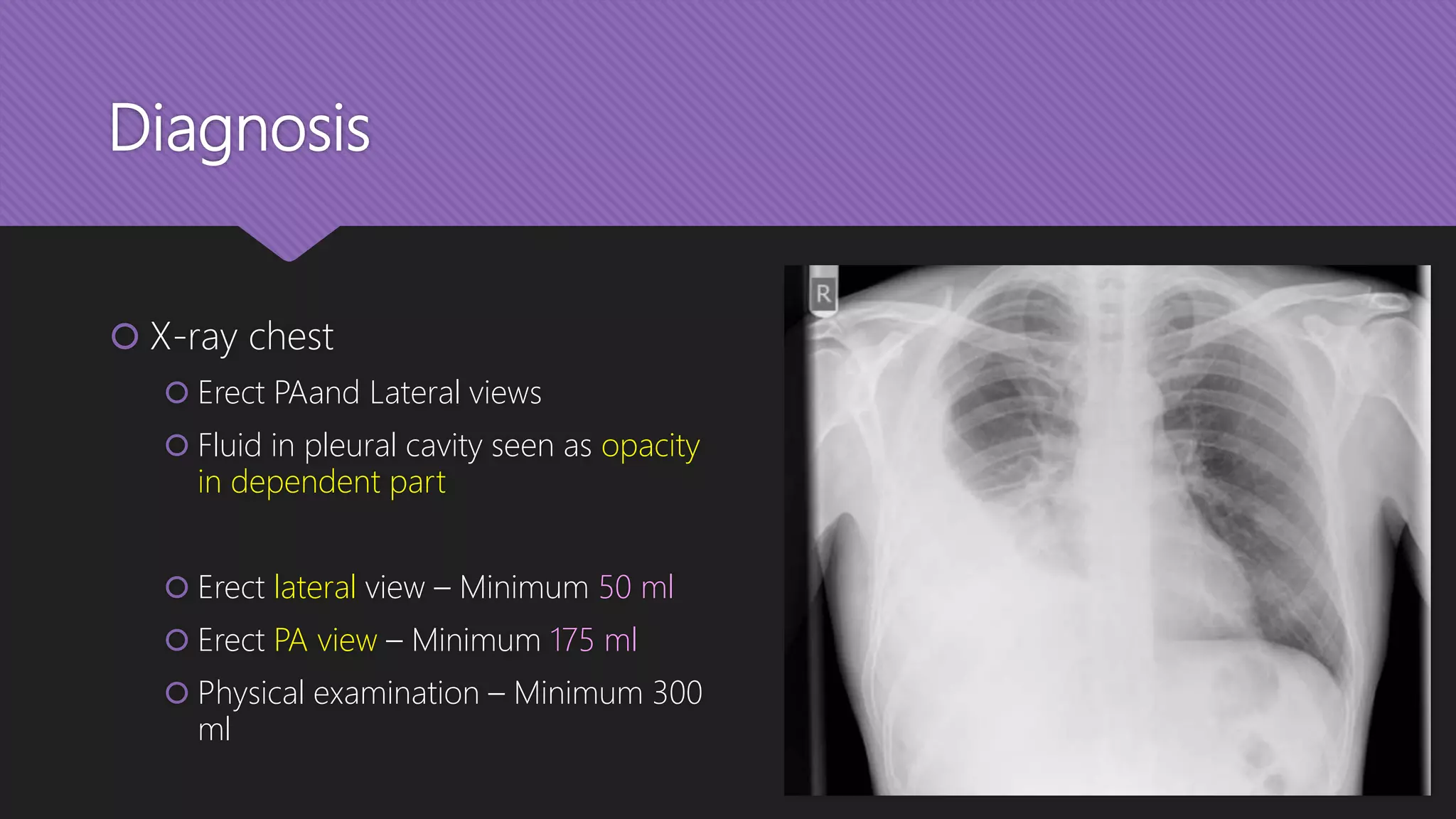 Diagnosis
 X-ray chest
 Erect PAand Lateral views
 Fluid in pleural cavity seen as opacity
in dependent part
 Erect lateral view – Minimum 50 ml
 Erect PA view – Minimum 175 ml
 Physical examination – Minimum 300
ml
 