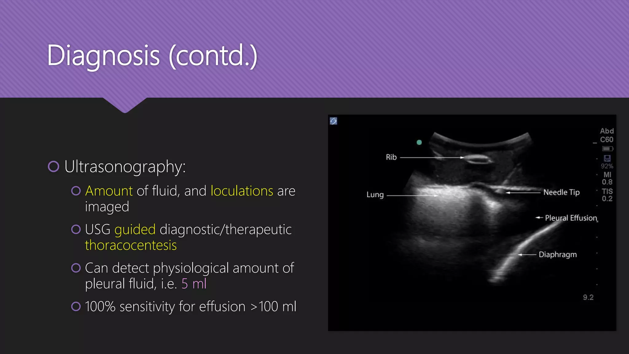Diagnosis (contd.)
 Ultrasonography:
 Amount of fluid, and loculations are
imaged
 USG guided diagnostic/therapeutic
thoracocentesis
 Can detect physiological amount of
pleural fluid, i.e. 5 ml
 100% sensitivity for effusion >100 ml
 