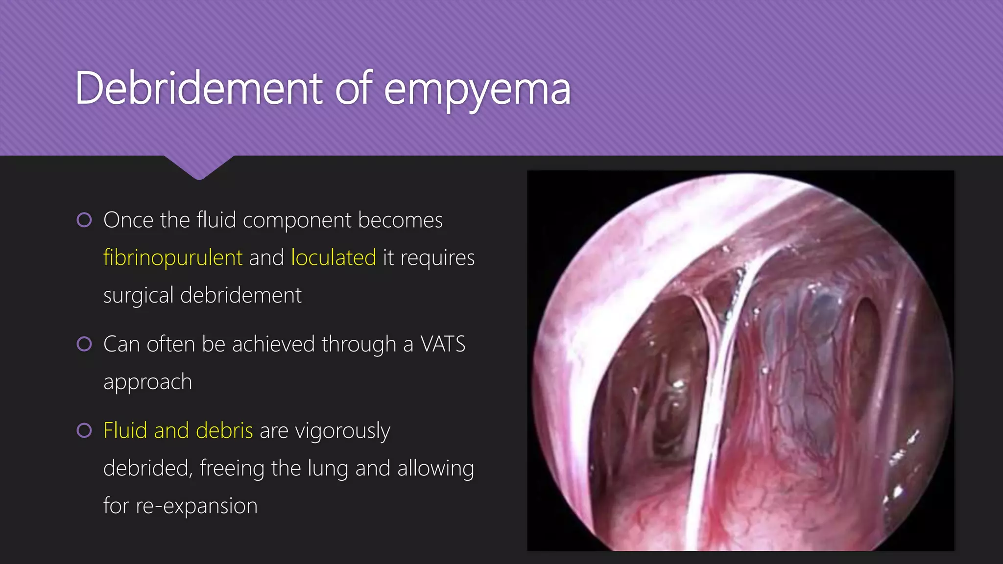 Debridement of empyema
 Once the fluid component becomes
fibrinopurulent and loculated it requires
surgical debridement
 Can often be achieved through a VATS
approach
 Fluid and debris are vigorously
debrided, freeing the lung and allowing
for re-expansion
 