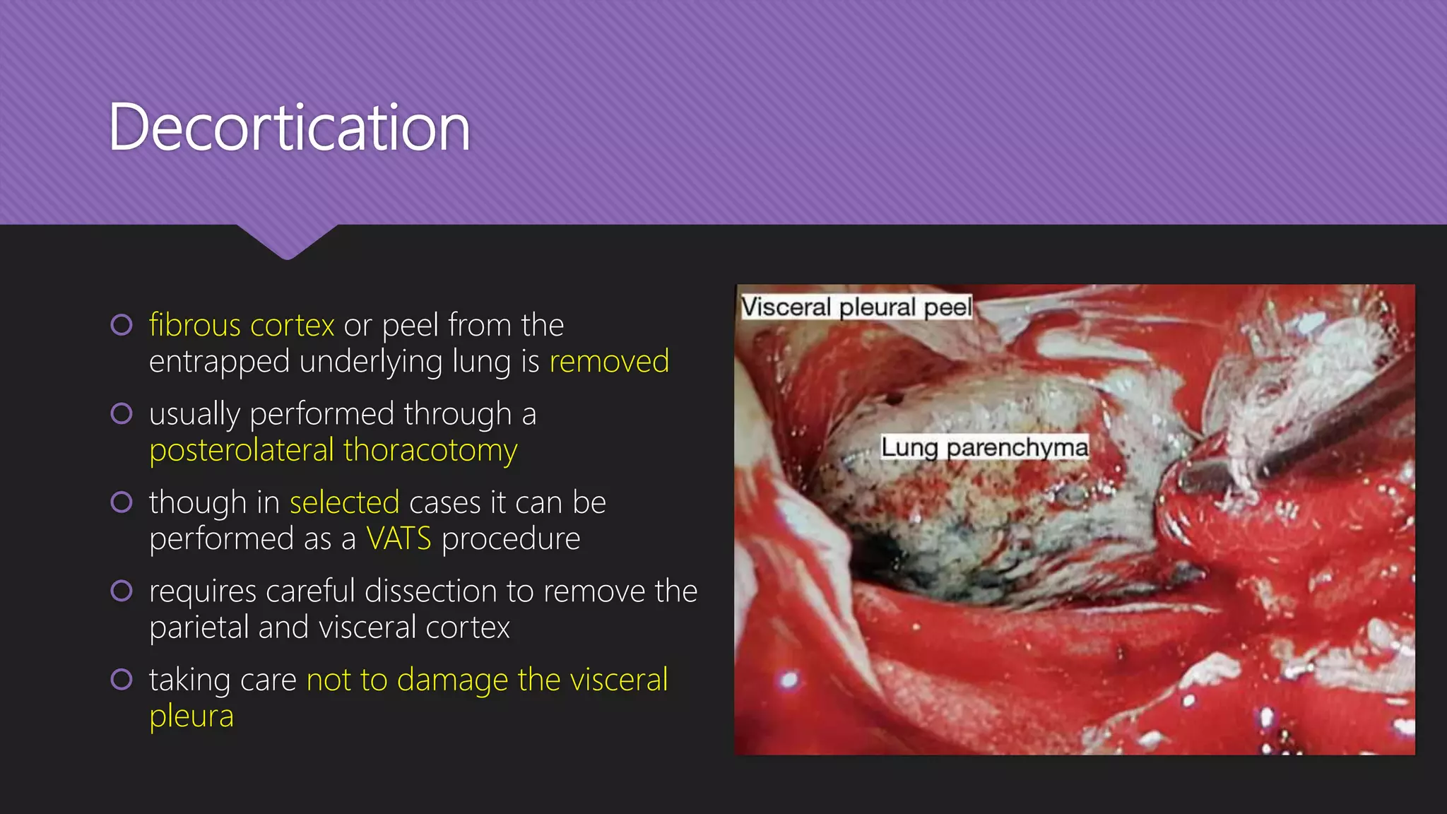 Decortication
 fibrous cortex or peel from the
entrapped underlying lung is removed
 usually performed through a
posterolateral thoracotomy
 though in selected cases it can be
performed as a VATS procedure
 requires careful dissection to remove the
parietal and visceral cortex
 taking care not to damage the visceral
pleura
 
