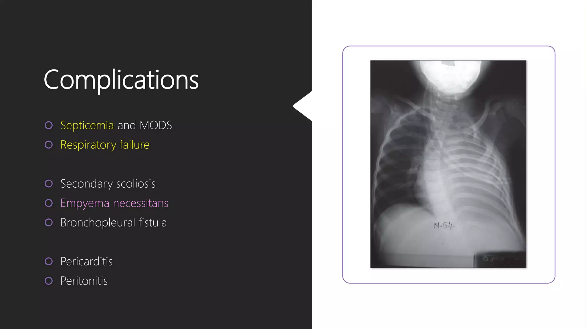 Complications
 Septicemia and MODS
 Respiratory failure
 Secondary scoliosis
 Empyema necessitans
 Bronchopleural fistula
 Pericarditis
 Peritonitis
 