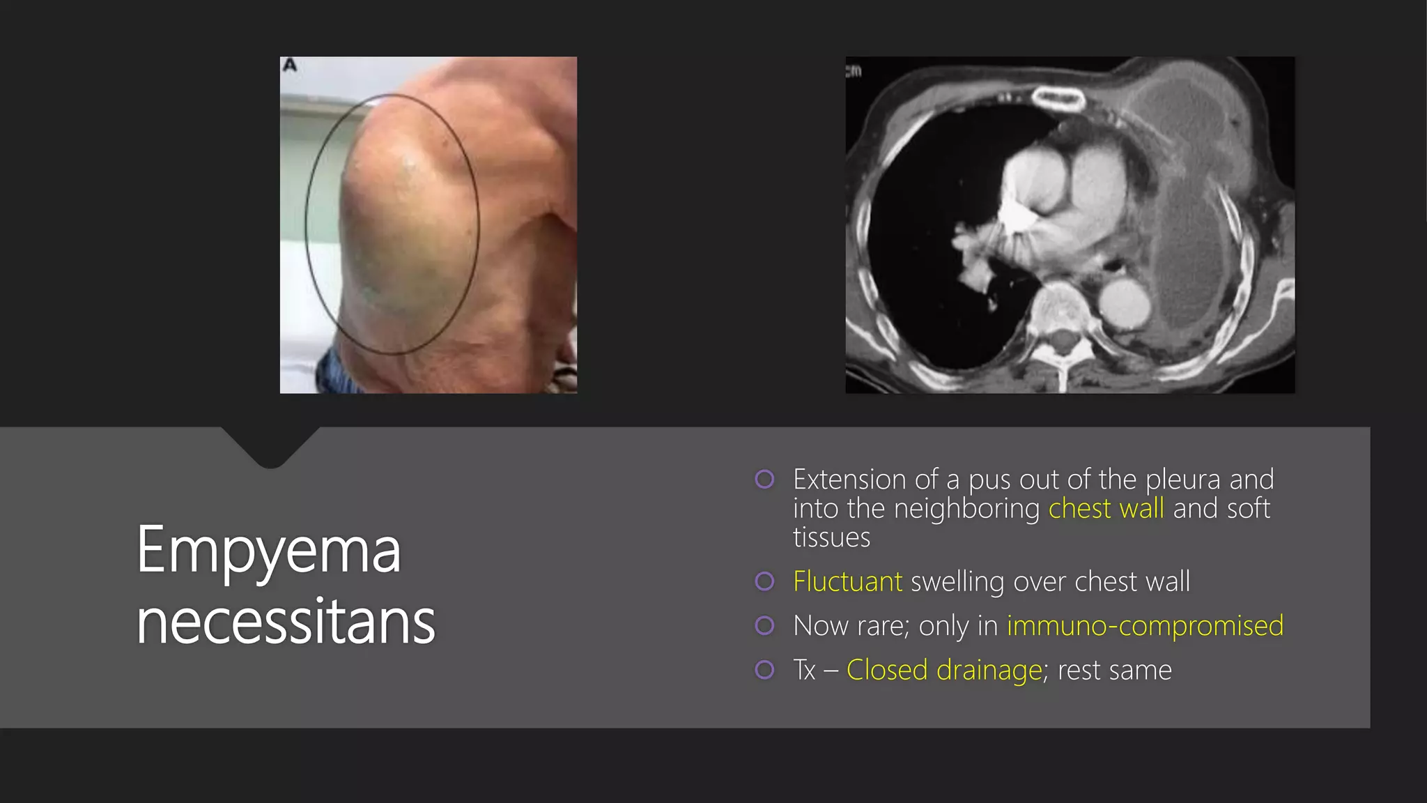 Empyema
necessitans
 Extension of a pus out of the pleura and
into the neighboring chest wall and soft
tissues
 Fluctuant swelling over chest wall
 Now rare; only in immuno-compromised
 Tx – Closed drainage; rest same
 