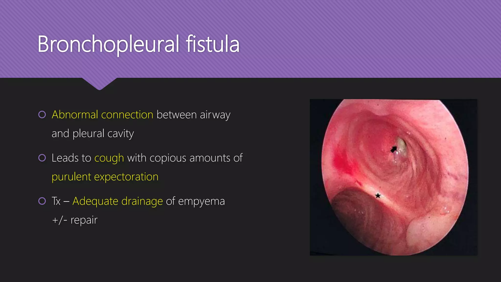 Bronchopleural fistula
 Abnormal connection between airway
and pleural cavity
 Leads to cough with copious amounts of
purulent expectoration
 Tx – Adequate drainage of empyema
+/- repair
 
