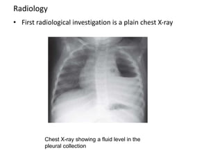 Radiology
• First radiological investigation is a plain chest X-ray
Chest X-ray showing a fluid level in the
pleural collection
 