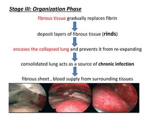 Stage III: Organization Phase
fibrous tissue gradually replaces fibrin
deposit layers of fibrous tissue (rinds)
encases the collapsed lung and prevents it from re-expanding
consolidated lung acts as a source of chronic infection
fibrous sheet , blood supply from surrounding tissues
 