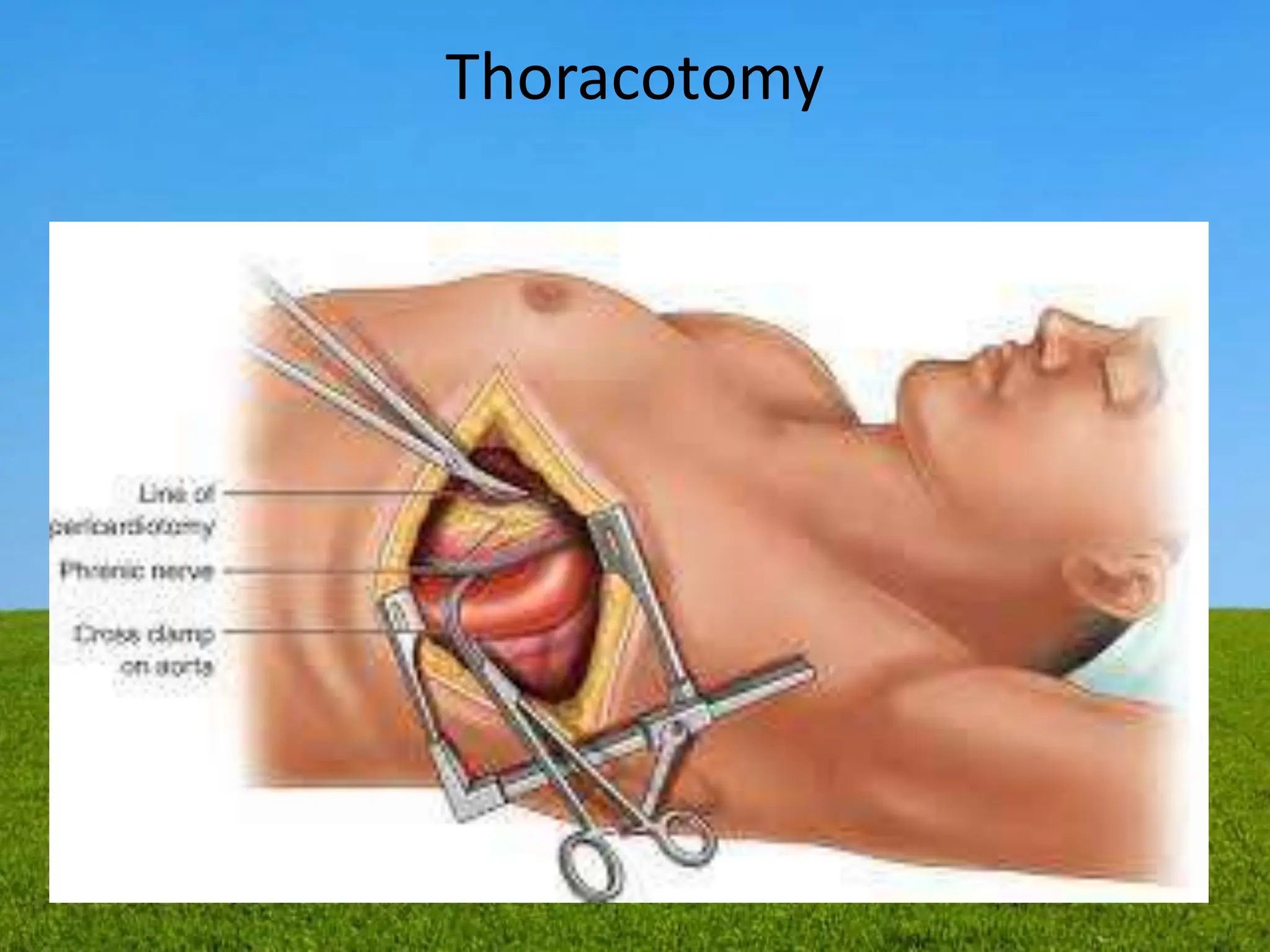 Thoracotomy
 