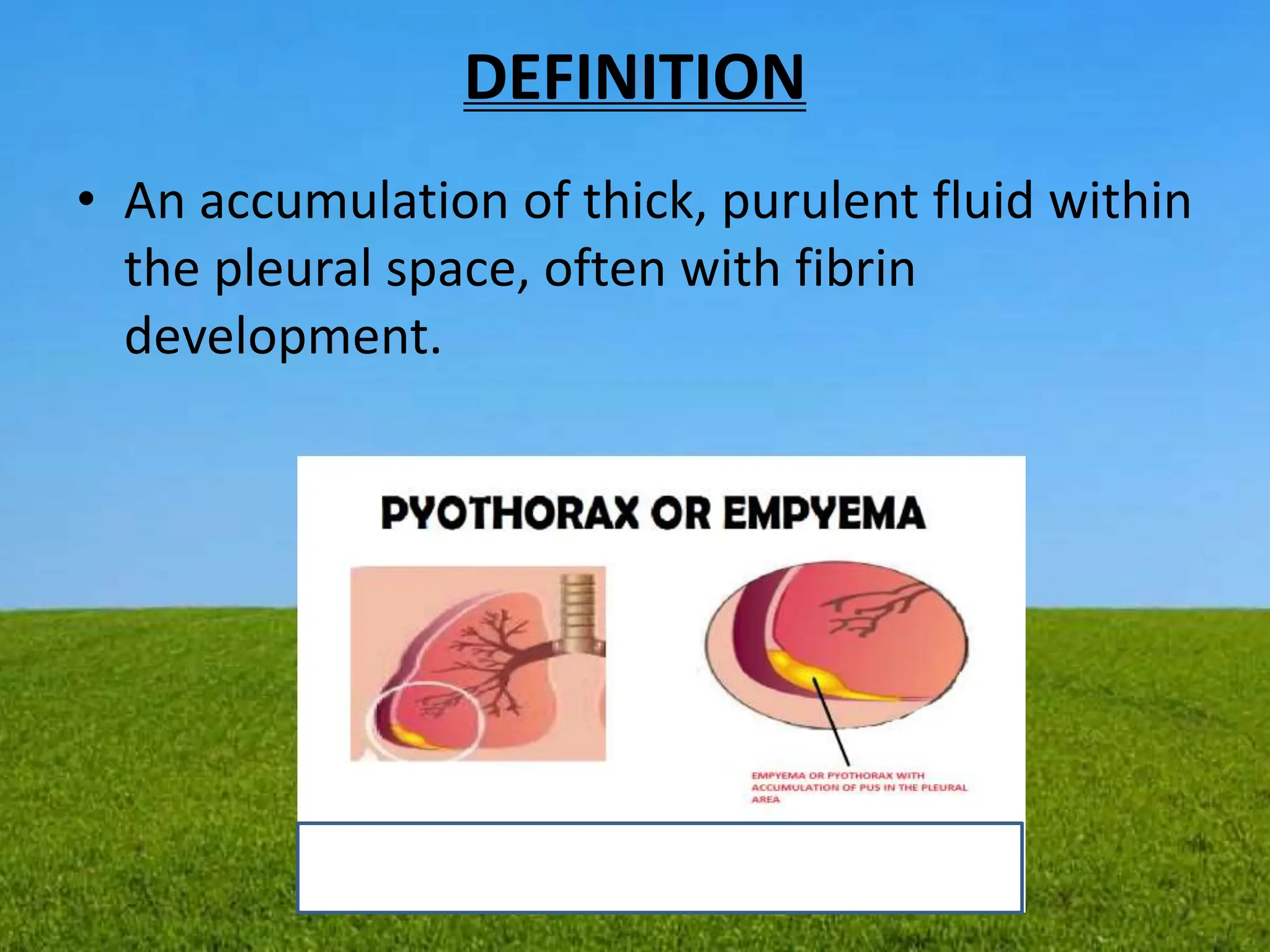 DEFINITION
• An accumulation of thick, purulent fluid within
the pleural space, often with fibrin
development.
 