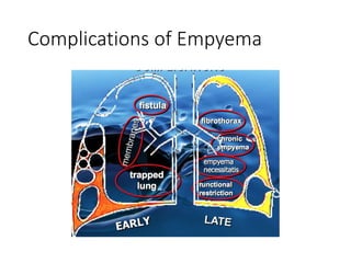 Empyema narthananan | PPTX