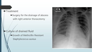 Treatment
Surgery for the drainage of abscess
with right anterior thoracotomy
Culture of drained fluid
Growth of Methicillin Resistant
Staphylococcus aureus
 