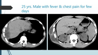 25 yrs. Male with fever & chest pain for few
days
 