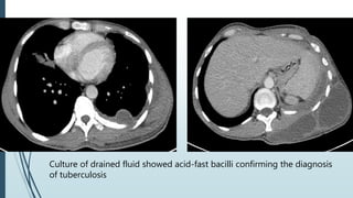 Culture of drained fluid showed acid-fast bacilli confirming the diagnosis
of tuberculosis
 