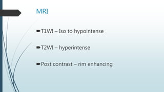 MRI
T1WI – Iso to hypointense
T2WI – hyperintense
Post contrast – rim enhancing
 