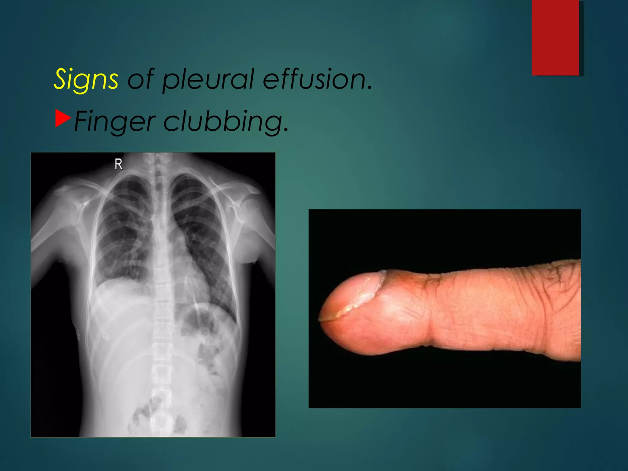 Signs of pleural effusion.
Finger clubbing.
 