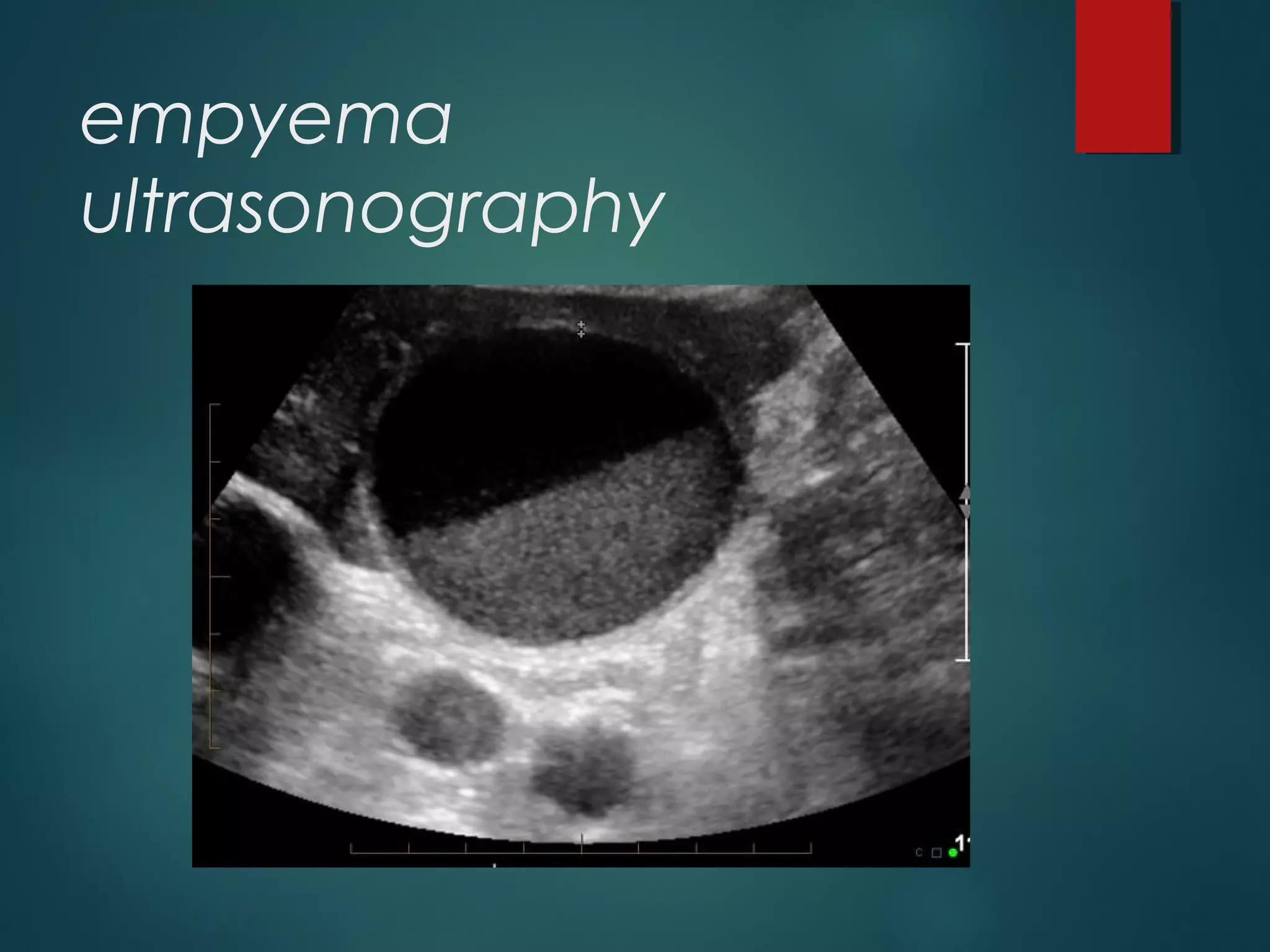 empyema
ultrasonography
 