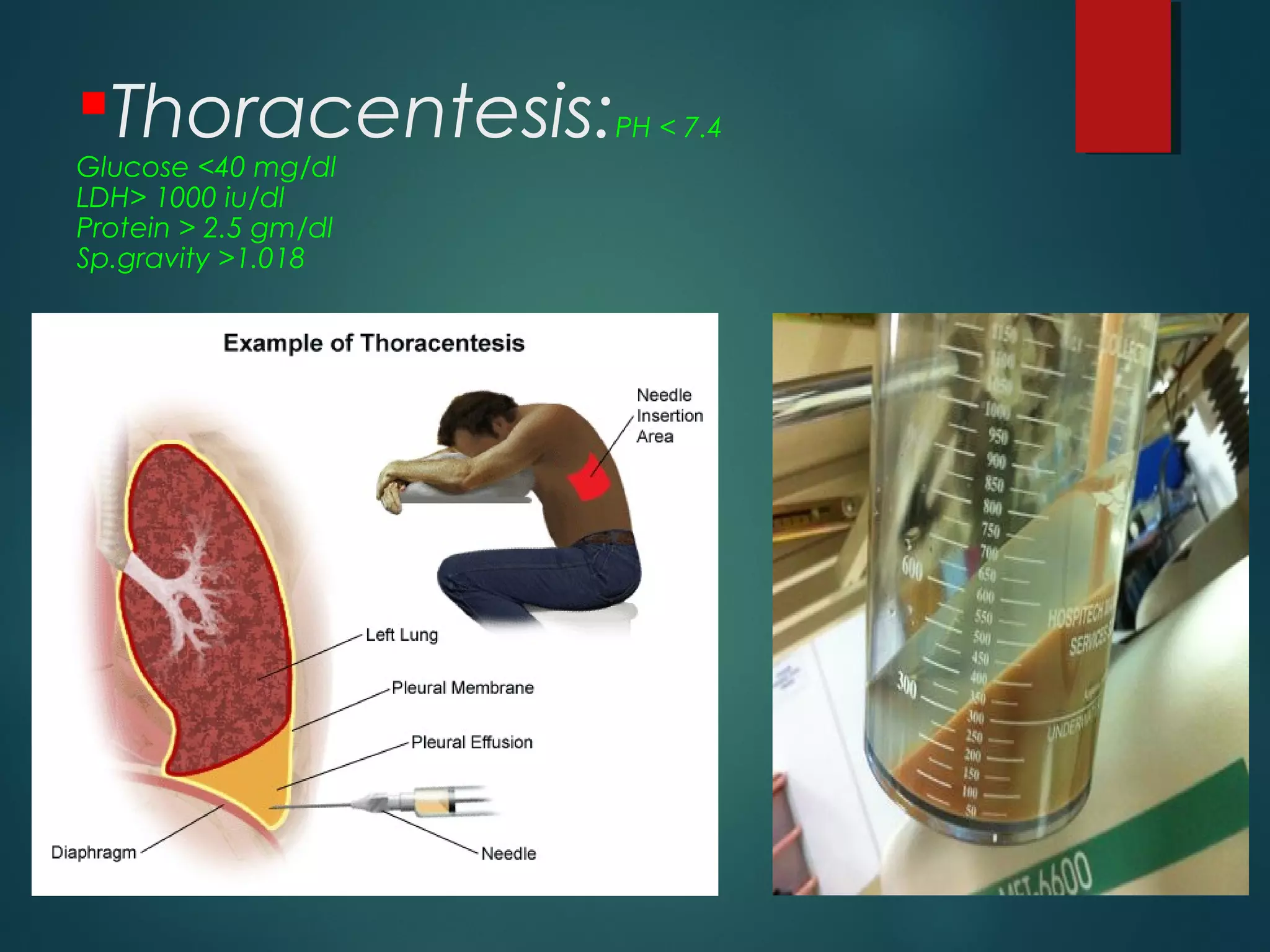 Thoracentesis:PH < 7.4
Glucose <40 mg/dl
LDH> 1000 iu/dl
Protein > 2.5 gm/dl
Sp.gravity >1.018
 