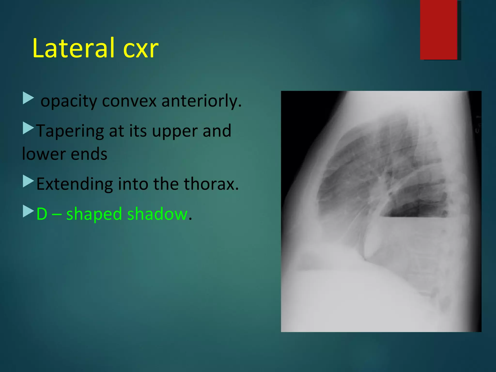 Lateral cxr
 opacity convex anteriorly.
Tapering at its upper and
lower ends
Extending into the thorax.
D – shaped shadow.
 