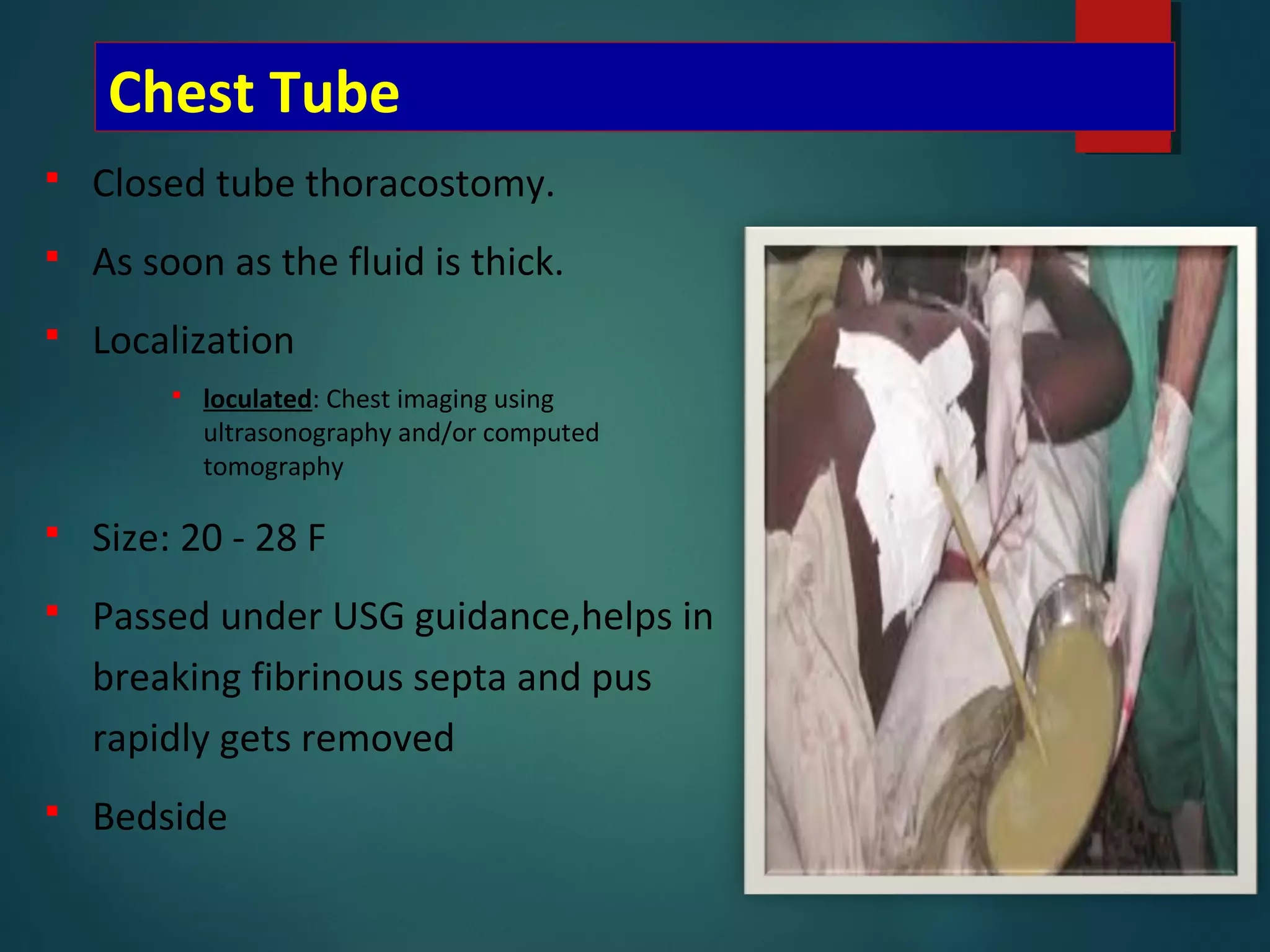Chest Tube
 Closed tube thoracostomy.
 As soon as the fluid is thick.
 Localization
 loculated: Chest imaging using
ultrasonography and/or computed
tomography
 Size: 20 - 28 F
 Passed under USG guidance,helps in
breaking fibrinous septa and pus
rapidly gets removed
 Bedside
 