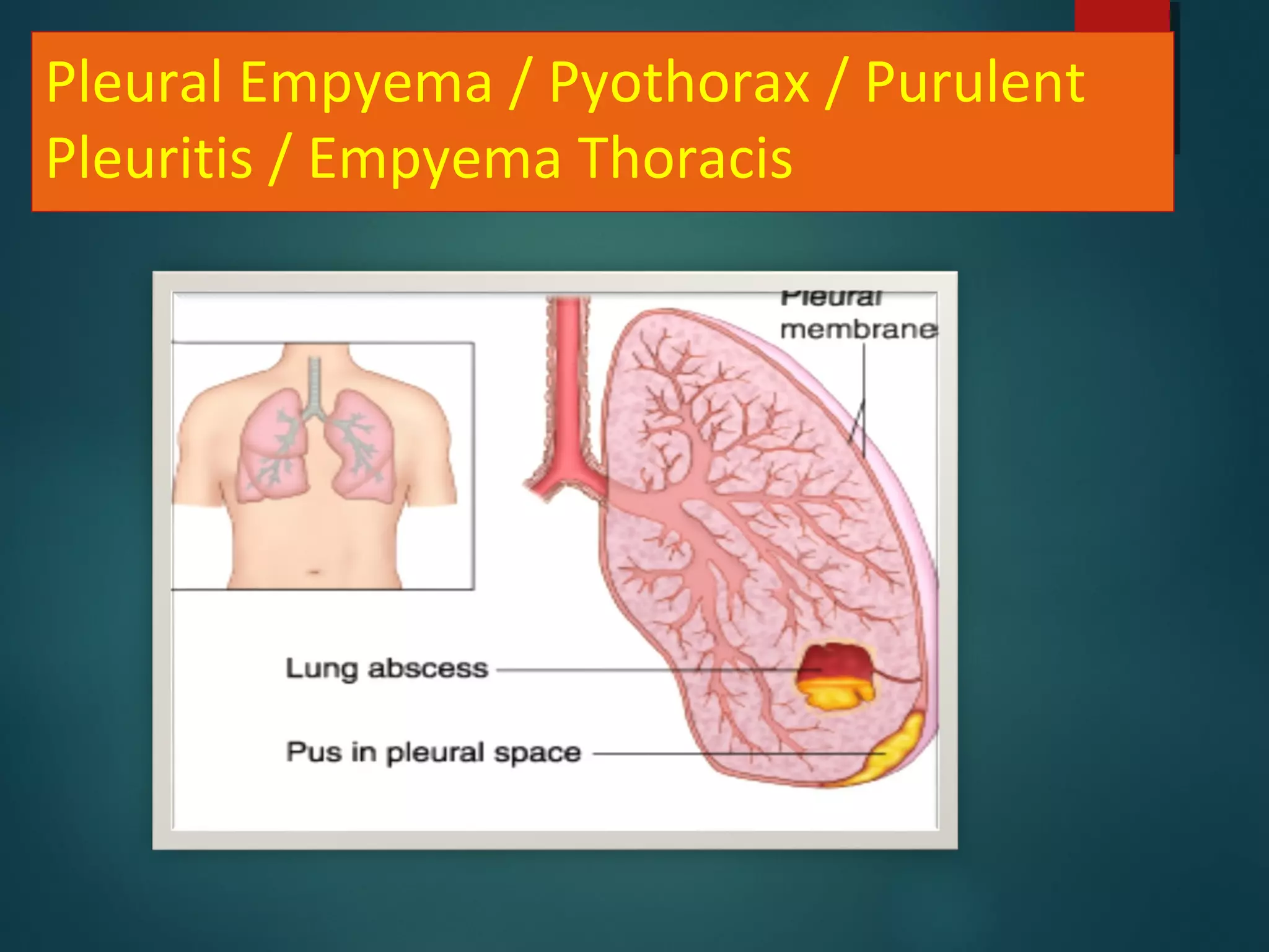 Pleural Empyema / Pyothorax / Purulent
Pleuritis / Empyema Thoracis
 