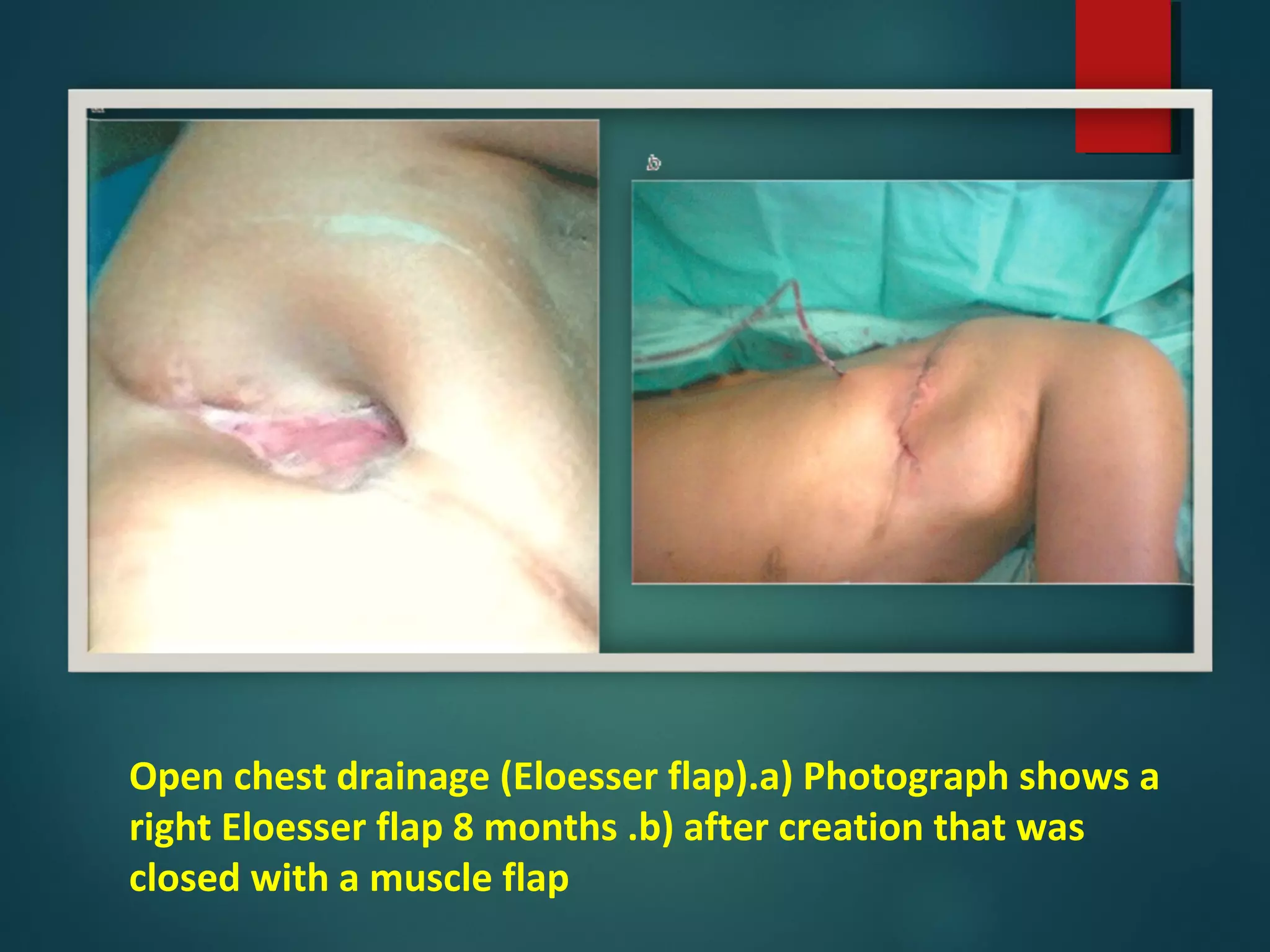 Open chest drainage (Eloesser flap).a) Photograph shows a
right Eloesser flap 8 months .b) after creation that was
closed with a muscle flap
 