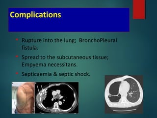 Complications
 Rupture into the lung; BronchoPleural
fistula.
 Spread to the subcutaneous tissue;
Empyema necessitans.
 Septicaemia & septic shock.
 
